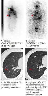 Primary presentation and clinical course of pediatric and adolescent patients with differentiated thyroid carcinoma after radioiodine therapy